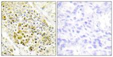 DLX5 Antibody - Peptide - + Immunohistochemistry analysis of paraffin-embedded human lung carcinoma tissue using DLX5 antibody.