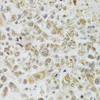 DMAP1 Antibody - Immunohistochemistry of paraffin-embedded human lung cancer tissue.