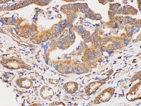 DMBT1 Antibody - Immunohistochemistry of paraffin-embedded Human duodenal cancer using DMBT1 Polycloanl Antibody at dilution of 1:300