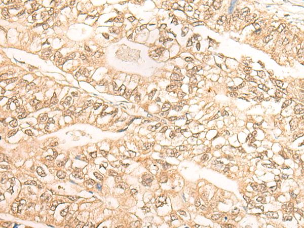 DMC1 Antibody - Immunohistochemistry of paraffin-embedded Human gastric cancer tissue  using DMC1 Polyclonal Antibody at dilution of 1:30(×200)