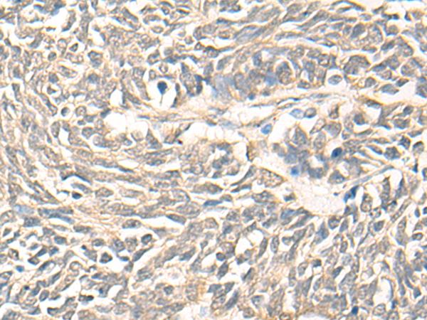 DMC1 Antibody - Immunohistochemistry of paraffin-embedded Human lung cancer tissue  using DMC1 Polyclonal Antibody at dilution of 1:30(×200)