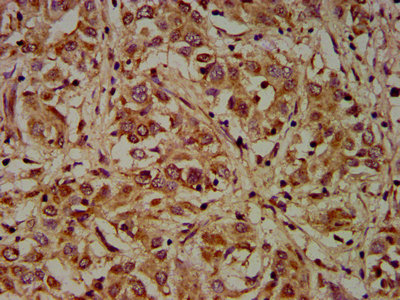 DMD / Dystrophin Antibody - Immunohistochemistry Dilution at 1:200 and staining in paraffin-embedded human liver cancer performed on a Leica BondTM system. After dewaxing and hydration, antigen retrieval was mediated by high pressure in a citrate buffer (pH 6.0). Section was blocked with 10% normal Goat serum 30min at RT. Then primary antibody (1% BSA) was incubated at 4°C overnight. The primary is detected by a biotinylated Secondary antibody and visualized using an HRP conjugated SP system.