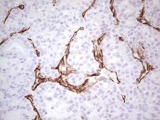DMN / Desmuslin / Synemin Antibody - Immunohistochemical staining of paraffin-embedded Carcinoma of Human thyroid tissue using anti-SYNM mouse monoclonal antibody. (Heat-induced epitope retrieval by 1 mM EDTA in 10mM Tris, pH8.5, 120C for 3min,