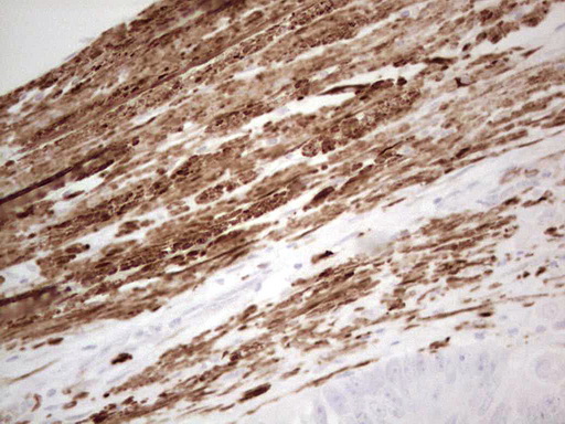 DMN / Desmuslin / Synemin Antibody - Immunohistochemical staining of paraffin-embedded Adenocarcinoma of Human colon tissue using anti-SYNM mouse monoclonal antibody. (Heat-induced epitope retrieval by 1 mM EDTA in 10mM Tris, pH8.5, 120C for 3min,