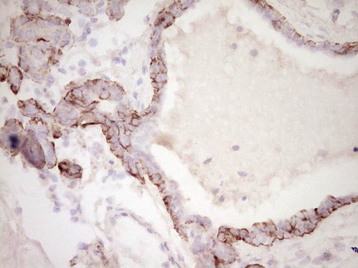 DMN / Desmuslin / Synemin Antibody - Immunohistochemical staining of paraffin-embedded Adenocarcinoma of Human breast tissue using anti-SYNM mouse monoclonal antibody. (Heat-induced epitope retrieval by 1 mM EDTA in 10mM Tris, pH8.5, 120C for 3min,