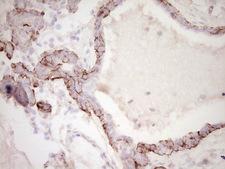 DMN / Desmuslin / Synemin Antibody - IHC of paraffin-embedded Adenocarcinoma of Human breast tissue using anti-SYNM mouse monoclonal antibody. (Heat-induced epitope retrieval by 1 mM EDTA in 10mM Tris, pH8.5, 120°C for 3min).