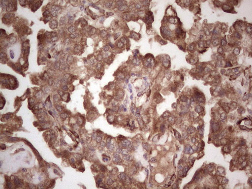 DMN / Desmuslin / Synemin Antibody - Immunohistochemical staining of paraffin-embedded Adenocarcinoma of Human ovary tissue using anti-SYNM mouse monoclonal antibody.  heat-induced epitope retrieval by 1 mM EDTA in 10mM Tris, pH8.5, 120C for 3min)