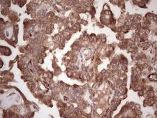 DMN / Desmuslin / Synemin Antibody - Immunohistochemical staining of paraffin-embedded Adenocarcinoma of Human ovary tissue using anti-SYNM mouse monoclonal antibody.  heat-induced epitope retrieval by 1 mM EDTA in 10mM Tris, pH8.5, 120C for 3min)