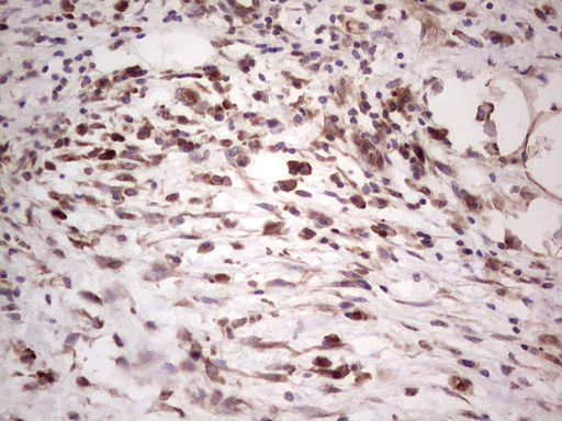 DMN / Desmuslin / Synemin Antibody - Immunohistochemical staining of paraffin-embedded Carcinoma of Human pancreas tissue using anti-SYNM mouse monoclonal antibody.  heat-induced epitope retrieval by 1 mM EDTA in 10mM Tris, pH8.5, 120C for 3min)