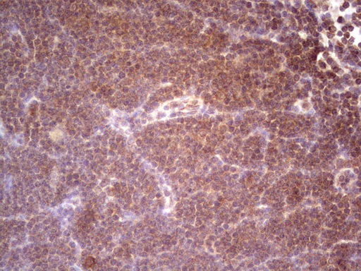 DMN / Desmuslin / Synemin Antibody - Immunohistochemical staining of paraffin-embedded Human lymphoma tissue using anti-SYNM mouse monoclonal antibody.  heat-induced epitope retrieval by 1 mM EDTA in 10mM Tris, pH8.5, 120C for 3min)