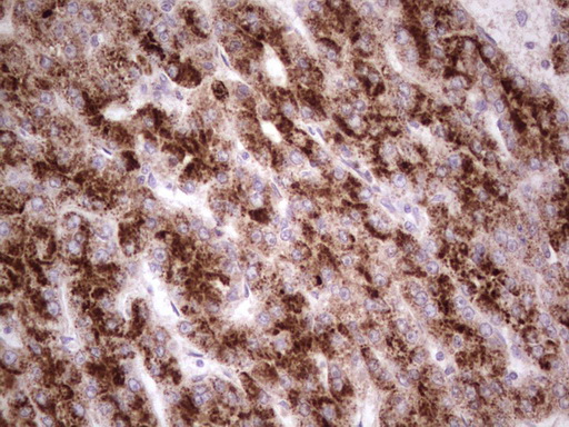 DMN / Desmuslin / Synemin Antibody - Immunohistochemical staining of paraffin-embedded Carcinoma of Human liver tissue using anti-SYNM mouse monoclonal antibody.  heat-induced epitope retrieval by 1 mM EDTA in 10mM Tris, pH8.5, 120C for 3min)