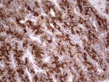 DMN / Desmuslin / Synemin Antibody - IHC of paraffin-embedded Carcinoma of Human liver tissue using anti-SYNM mouse monoclonal antibody. (heat-induced epitope retrieval by 1 mM EDTA in 10mM Tris, pH8.5, 120°C for 3min).