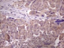 DMRT1 Antibody - Immunohistochemical staining of paraffin-embedded Adenocarcinoma of Human ovary tissue using anti-DMRT1 mouse monoclonal antibody. (Heat-induced epitope retrieval by 1 mM EDTA in 10mM Tris, pH8.5, 120C for 3min. (1:150)