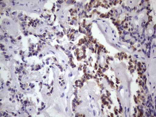 DMRT1 Antibody - Immunohistochemical staining of paraffin-embedded Carcinoma of Human pancreas tissue using anti-DMRT1 mouse monoclonal antibody. (Heat-induced epitope retrieval by 1 mM EDTA in 10mM Tris, pH8.5, 120C for 3min. (1:150)