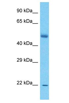 DMRT1 Antibody - DMT1 / DMRT1 antibody Western Blot of Esophagus Tumor. Antibody dilution: 1 ug/ml.  This image was taken for the unconjugated form of this product. Other forms have not been tested.