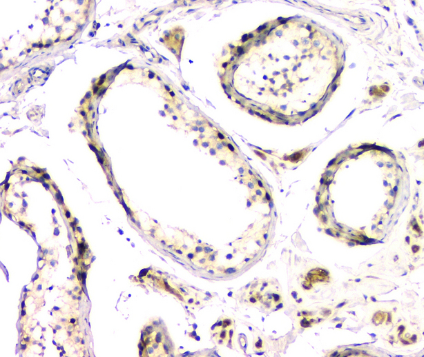 DMRT1 Antibody - IHC analysis of DMRT1 using anti-DMRT1 antibody. DMRT1 was detected in paraffin-embedded section of human testis tissue. Heat mediated antigen retrieval was performed in citrate buffer (pH6, epitope retrieval solution) for 20 mins. The tissue section was blocked with 10% goat serum. The tissue section was then incubated with 1µg/ml rabbit anti-DMRT1 Antibody overnight at 4°C. Biotinylated goat anti-rabbit IgG was used as secondary antibody and incubated for 30 minutes at 37°C. The tissue section was developed using Strepavidin-Biotin-Complex (SABC) with DAB as the chromogen.