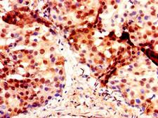 DMRT1 Antibody - Immunohistochemistry of paraffin-embedded human breast cancer using DMRT1 Antibody at dilution of 1:100