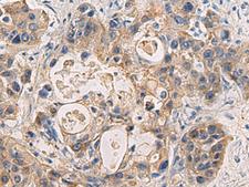 DMRTA2 Antibody - Immunohistochemistry of paraffin-embedded Human liver cancer tissue  using DMRTA2 Polyclonal Antibody at dilution of 1:50(×200)