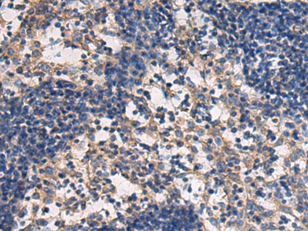 DMRTA2 Antibody - Immunohistochemistry of paraffin-embedded Human esophagus cancer tissue  using DMRTA2 Polyclonal Antibody at dilution of 1:50(×200)