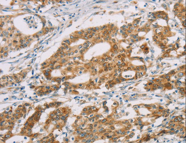 DMRTA3 / DMRT3 Antibody - Immunohistochemistry of paraffin-embedded Human gastric cancer using DMRT3 Polyclonal Antibody at dilution of 1:25.