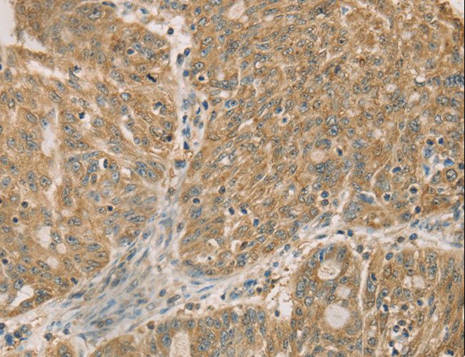 DMRTA3 / DMRT3 Antibody - Immunohistochemistry of paraffin-embedded Human ovarian cancer using DMRT3 Polyclonal Antibody at dilution of 1:50.