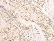 DMTN / Dematin Antibody - Immunohistochemistry of paraffin-embedded Human gastric cancer tissue  using DMTN Polyclonal Antibody at dilution of 1:35(×200)