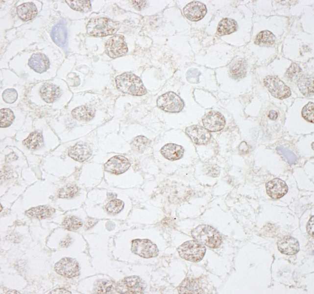 DMWD Antibody - Detection of Human DMWD by Immunohistochemistry. Sample: FFPE section of human seminoma. Antibody: Affinity purified rabbit anti-DMWD used at a dilution of 1:250.