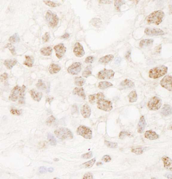 DMWD Antibody - Detection of Human DMWD by Immunohistochemistry. Sample: FFPE section of human breast carcinoma. Antibody: Affinity purified rabbit anti-DMWD used at a dilution of 1:250.