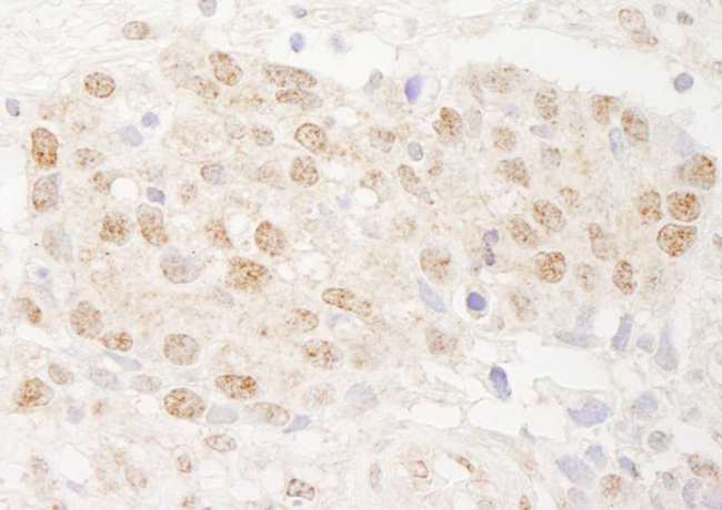DMWD Antibody - Detection of Human DMWD by Immunohistochemistry. Sample: FFPE section of human breast carcinoma. Antibody: Affinity purified rabbit anti-DMWD used at a dilution of 1:1000 (1 ug/ml). Detection: DAB.