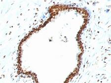 DNA ds Antibody - Formalin-fixed, paraffin-embedded human colon carcinoma stained with dsDNA antibody (121-3).  This image was taken for the unmodified form of this product. Other forms have not been tested.