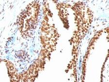 DNA ds Antibody - Formalin-fixed, paraffin-embedded human colon carcinoma stained with dsDNA antibody (AE-2).  This image was taken for the unmodified form of this product. Other forms have not been tested.