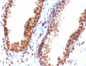 DNA ds Antibody - IHC testing of FFPE human colon carcinoma with dsDNA antibody (clone DRNC1-1).  This image was taken for the unmodified form of this product. Other forms have not been tested.