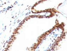 DNA ds Antibody - Formalin-fixed, paraffin-embedded human colon carcinoma stained with Double Stranded DNA antibody (DSD/958).  This image was taken for the unmodified form of this product. Other forms have not been tested.