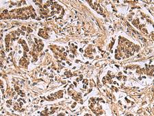 DNA2 Antibody - Immunohistochemistry of paraffin-embedded Human breast cancer tissue  using DNA2 Polyclonal Antibody at dilution of 1:40(×200)