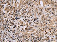 DNA2 Antibody - Immunohistochemistry of paraffin-embedded Human esophagus cancer tissue  using DNA2 Polyclonal Antibody at dilution of 1:60(×200)