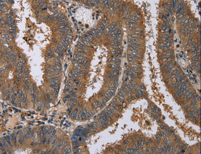 DNAJA1 / HDJ2 Antibody - Immunohistochemistry of paraffin-embedded Human colon cancer using DNAJA1 Polyclonal Antibody at dilution of 1:60.