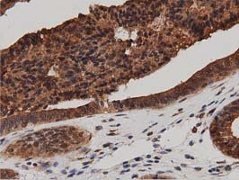 DNAJA2 Antibody - IHC of paraffin-embedded Adenocarcinoma of Human endometrium tissue using anti-DNAJA2 mouse monoclonal antibody. (Dilution 1:50).