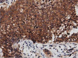 DNAJA2 Antibody - IHC of paraffin-embedded Carcinoma of Human bladder tissue using anti-DNAJA2 mouse monoclonal antibody. (Dilution 1:50).
