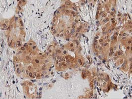 DNAJA2 Antibody - IHC of paraffin-embedded Carcinoma of Human thyroid tissue using anti-DNAJA2 mouse monoclonal antibody. (Dilution 1:50).