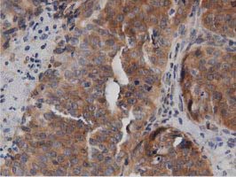 DNAJA2 Antibody - IHC of paraffin-embedded Adenocarcinoma of Human ovary tissue using anti-DNAJA2 mouse monoclonal antibody. (Dilution 1:50).