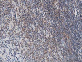 DNAJA2 Antibody - IHC of paraffin-embedded Human lymphoma tissue using anti-DNAJA2 mouse monoclonal antibody. (Dilution 1:50).