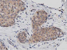 DNAJA2 Antibody - IHC of paraffin-embedded Adenocarcinoma of Human breast tissue using anti-DNAJA2 mouse monoclonal antibody. (Dilution 1:50).