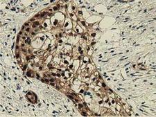 DNAJA2 Antibody - IHC of paraffin-embedded Carcinoma of Human pancreas tissue using anti-DNAJA2 mouse monoclonal antibody.