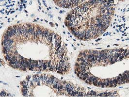 DNAJA2 Antibody - IHC of paraffin-embedded Adenocarcinoma of Human endometrium tissue using anti-DNAJA2 mouse monoclonal antibody.