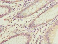 DNAJA2 Antibody - Immunohistochemistry of paraffin-embedded human colon cancer at dilution 1:100