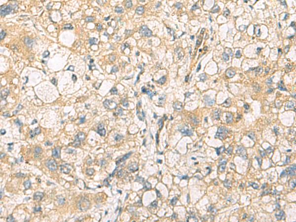 DNAJA4 Antibody - Immunohistochemistry of paraffin-embedded Human liver cancer tissue  using DNAJA4 Polyclonal Antibody at dilution of 1:55(×200)