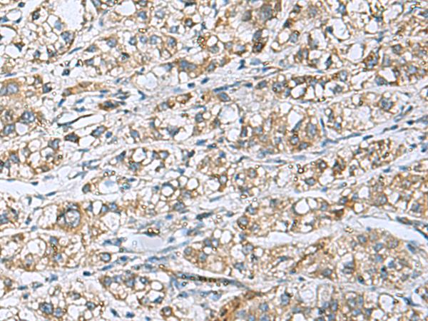 DNAJA4 Antibody - Immunohistochemistry of paraffin-embedded Human liver cancer tissue  using DNAJA4 Polyclonal Antibody at dilution of 1:50(×200)