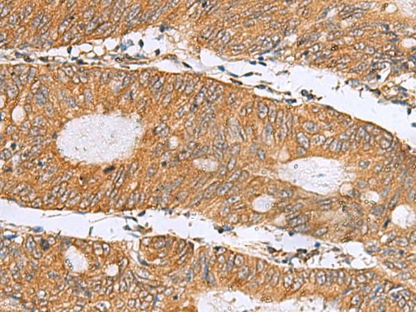 DNAJA4 Antibody - Immunohistochemistry of paraffin-embedded Human colorectal cancer tissue  using DNAJA4 Polyclonal Antibody at dilution of 1:50(×200)
