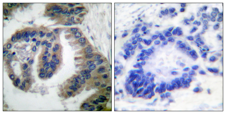 DNAJB1 / Hsp40 Antibody - Immunohistochemistry analysis of paraffin-embedded human lung carcinoma tissue, using HSP40 Antibody. The picture on the right is blocked with the synthesized peptide.