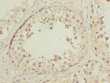 DNAJB1 / Hsp40 Antibody - Immunohistochemistry of paraffin-embedded human colon cancer using DNAJB1 Antibody at dilution of 1:100